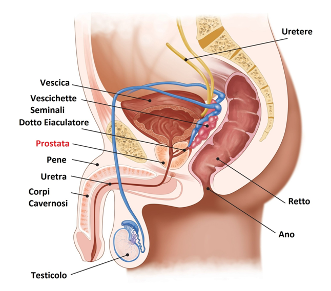 prostata ingrossata è un tumore