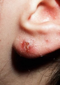 allergia al nichel da contatto. orecchino